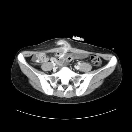 호전이없어서방선균증 (actinomycosis) 의가능성을고려하여추가로 doxycycline을경구 투여하고농과조직을채취하여병리과에의뢰하였으나만성염증소견외에유황과립 (sulfur granule) 등의특징적인소견은관찰되지않았다.