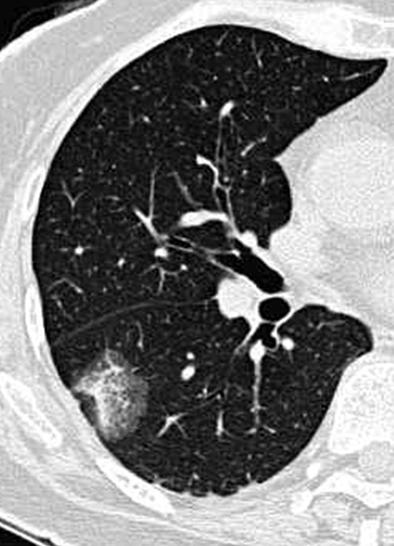 그러므로 ielcap의 protocol에서도염증이의심될경우에는항생제치료후 3개월후다시 chest CT 촬영을권장하고있다 (4). 지속성 nggo는 3개월이상크기의변화가없거나커지는 GGO 결절을의미한다. 본원에서 GGO로의뢰된환자에서 3개월후 chest CT를촬영하여 pggo의 37.6%, mggo의 48.