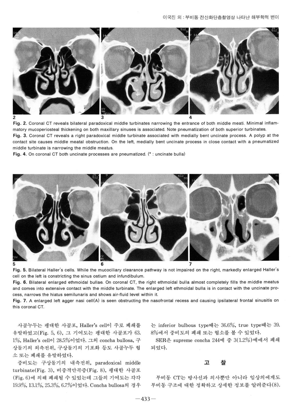 이국진오 1: 부비동전산화단층촬영상나타난해부학적변이 2 3 4 Fig. 2. Coronal CT reveals bilateral paradoxical middle turbinates narrowing the entrance 01 both middle meati.