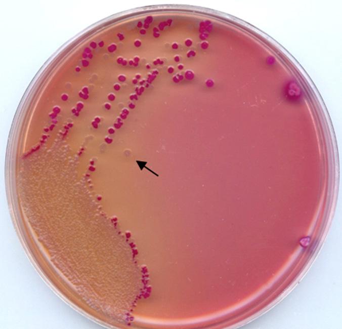 입원 1일째대변배양이의뢰되었다. 설사변에대해 Seeplex R Diarrhea ACE Detection Kit (Seegene, Seoul, Korea) 로세균성설사의원인균을찾기위해다중 PCR 검사를실시하여 E. coli O157 특이밴드, E. coli H7 특이밴드와 verotoxin 특이밴드에양성결과를얻었다 (Fig. 1).