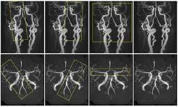 Wong EC, NeuroImage 2006 Garcia, de Bazelaire & Alsop, ISMRM 2005 VTI 영상법은 PASL 방법을이용하여일부 feeding artery 만을 labeling 하는방법임.