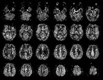 subtraction=cbf CMRO2 Improved Reliability with DIPLOMA ASL Whole Brain ASL Perfusion MRI at 4T ICC DIPLOMA EPISTAR PICORE Global 0.81 0.78 0.