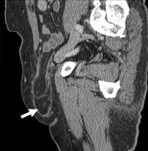 . Sagittal reformatted image shows more well delineation of precise hernia shape (arrow). Fig. 9.