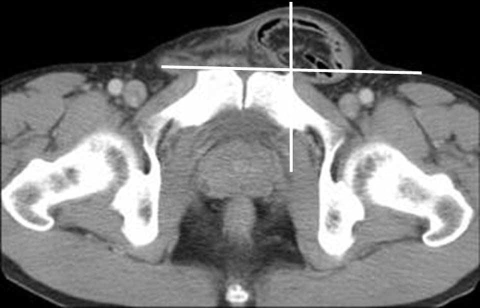 The orthogonal lines identify this hernia as femoral as it lies in the posterolateral quadrant.. xial MDCT scan in a patient with an indirect inguinal hernia.