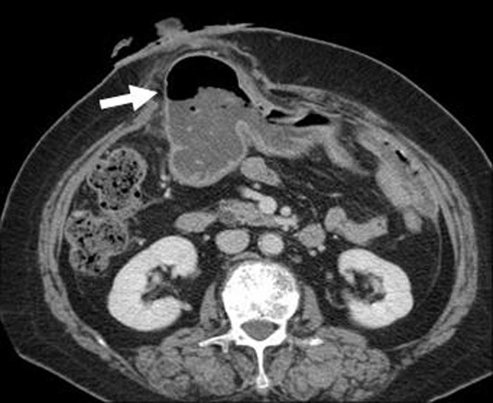 김신영외 : 다중검출기전산화단층촬영 (MDCT) 에서보이는복벽탈장의다양한영상소견 Fig. 15. 70-year-old woman with abdominal pain and previous debulking operation with colostomy for ovarian cancer and carcinomatosis peritonei.