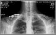 injury 팔을밖으로펴서떨어질때 어깨로떨어질때 직접적인충격 Mid 1/3 fracture In adult : more than two-thirds of clavicle fractures In children : up to 90% of clavicle fractures 쇄골골절 Fracture of the Clavicle