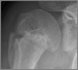 Sports injury Little league shoulder 14 M, 야구투수 견갑골이상운동증 SICK scapular syndrome -Warner