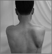 of scapular motion from behind the patient during Flexion & Scaption Type 1 Type 2 Type