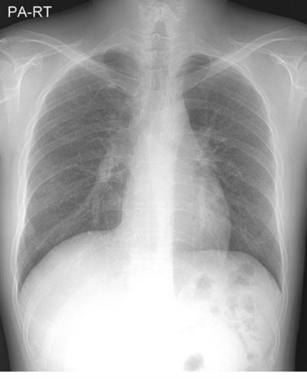 glass attenuation and tiny, ill-defined centrilobular nodules on upper and lower lung field. Figure 3.