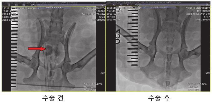 The Korean Urological Congress and Expo: 2015 KUCE P-50 Comparison of post-operative safety profile in tubeless percutaneous nephrolithotomy according to type of sealant 박준형, 정현우, 서윤석, 김정준,