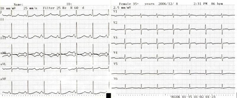 김도형외 9 인 : 폐고혈압을동반한전격성제 1 형당뇨병 1 예 A B Fig. 1. Electrocardiograms showing nonspecific ST-T-wave abnormalities.