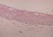 Normal oral mucosa The cytokeratin 10/13 expression is found in the entire