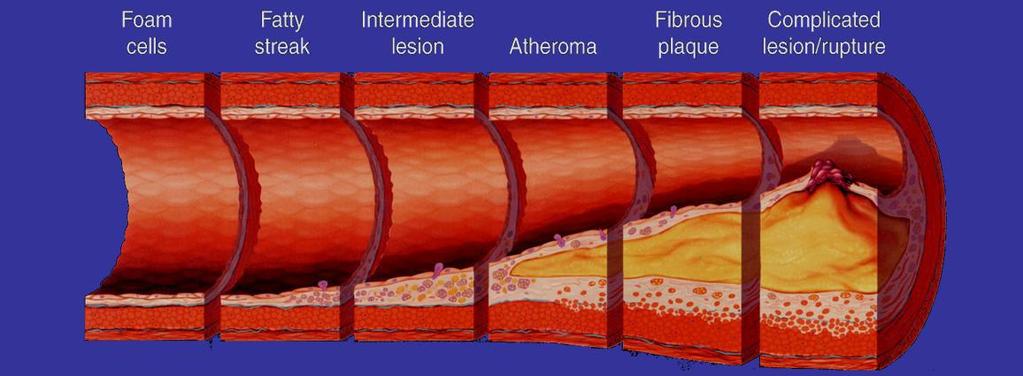 Atherosclerosis is the Most Common Pathologic Condition Leading to Cardiovascular Disease 1 A dynamic disease process clinically characterized by narrowing of the arterial lumen due to