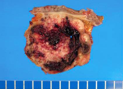 Cell Tumors in Abdomen 15