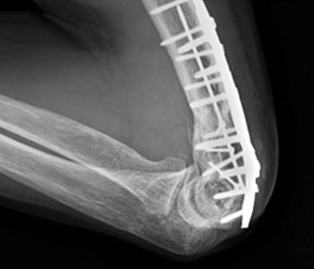 주두골불유합의분류는정해진것이없는상태이나 Rotini 등 13) 은근위척골의불유합을주두끝에서 5 cm 을기준으로골간단 - 골단형 (meta-epiphyseal lesion) 과골간단 - 골간형 (meta-diaphyseal lesion) 으로분류한바가있으며골간단 -