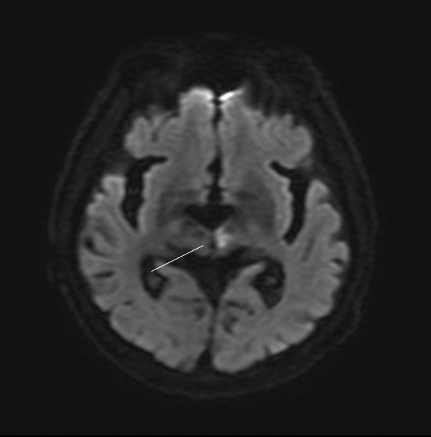 이원구 외 2인. 외전마비와 불완전 하전마비를 동반한 수직하나반증후군 Fig. 2. Brain magnetic resonance imaging of the patient.
