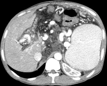 범혈구감소증을동반한간경변환자의소화불량증례보고 Fig. 1. Liver CT. 2) 상부소화관내시경 (2016년 5월 2일 )(Fig. 2) : E. varix, F2. Dieulafoy lesion hemoclipping site intact, anastomosis site, s/p STG d/t gastric ulcer. Gastric varix Fig.