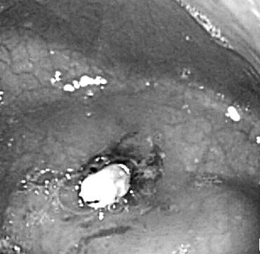 이용욱외 : 신생아위 Dieulafoy 병변의내시경적치료 1 예ㆍ 395 Fig. 3. Endoscopic view of Dieulafoy's lesion showing e- ndoscopic hemoclipping (A).