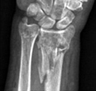 A 71-year-old woman with an AO/OTA classification C3.2 type fracture.