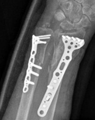 A 78-year-old woman with an AO/OTA