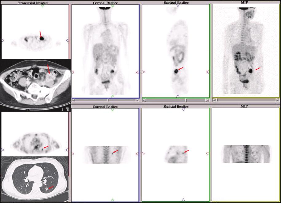 - 대한내과학회지 : 제 74 권부록 2 호 2008 - Figure 1. 대장암환자의전신 FDG PET 영상. 원발부위외에약 5 mm 크기의폐전이가관찰된다. 병기측정으로같이시행한 CT 는간과폐의기저부위만포함되어폐전이를찾지못하였다.