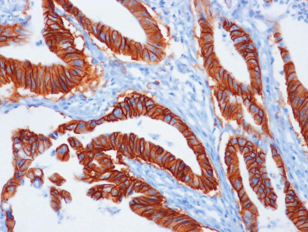 growth factor receptor 2 (HER2) in gastric cancer.