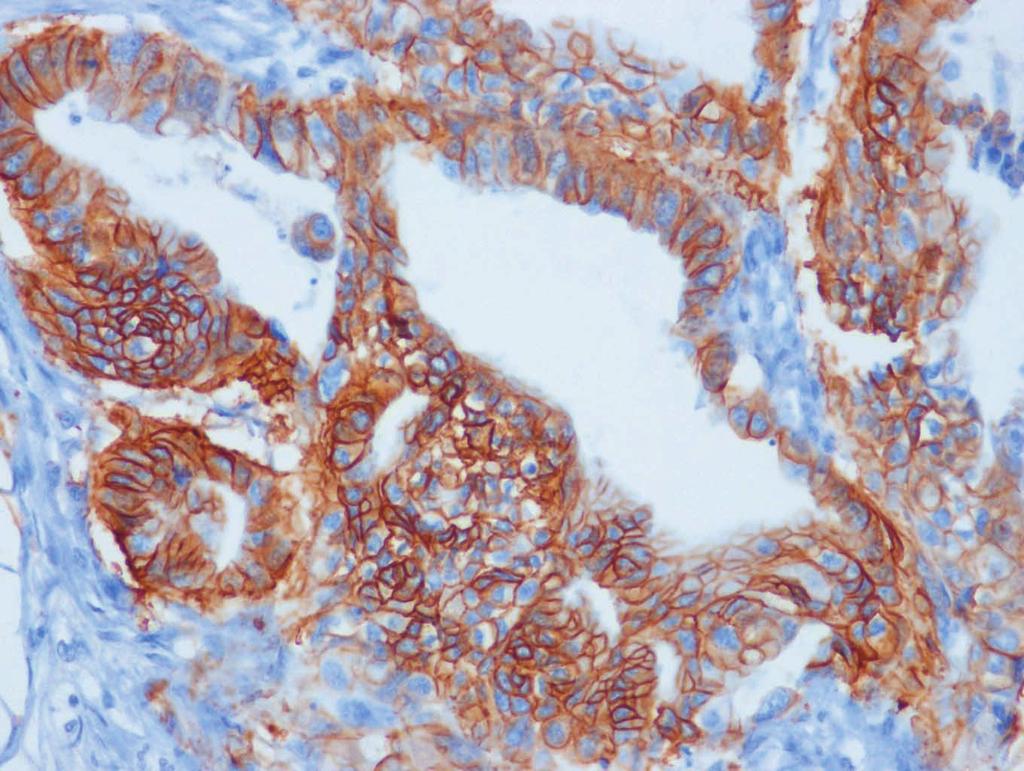 positive staining in a metastatic tumor of a regional lymph node (F).