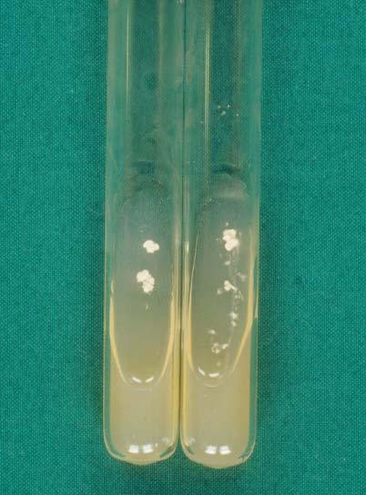 강교신등 : 와상백선의양상을보인 Trichophyton verrucosum 에의한몸백선 1 예 Fig. 5.