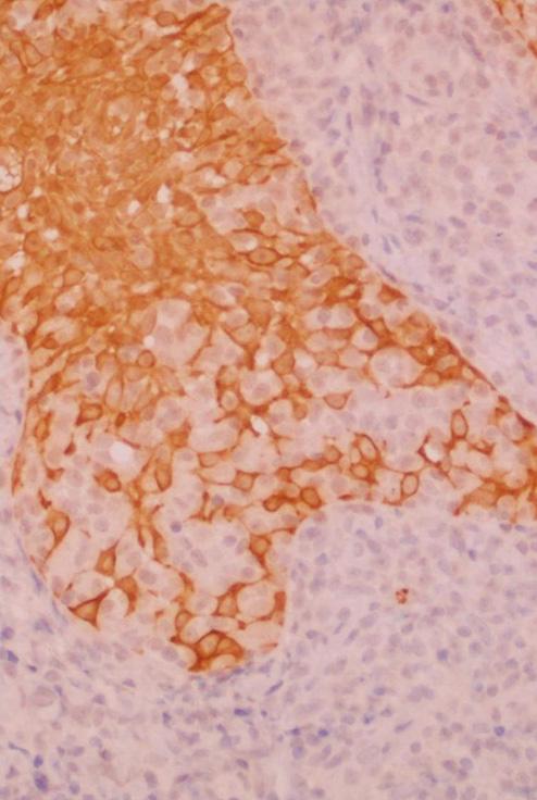 712 대한피부과학회지 : 제 46 권제 5 호 2008 년 형질세포양세포와소림프구가섞여있었으며, 일부에서는세포분열중인세포들도발견되었다 (Fig. 2C).