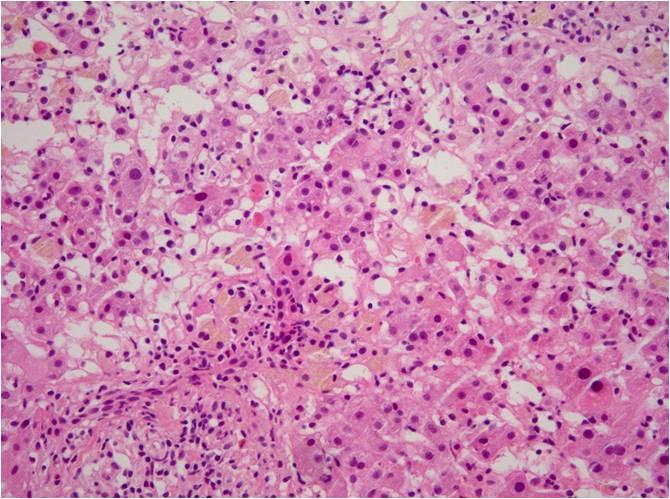 (A) Toxic hepatitis, hepatocellular type: severe lobular hepatitis with apoptotic and ballooning hepatocytes. Neutrophils and eosinophils are also present in the lobule (H&E, 200).
