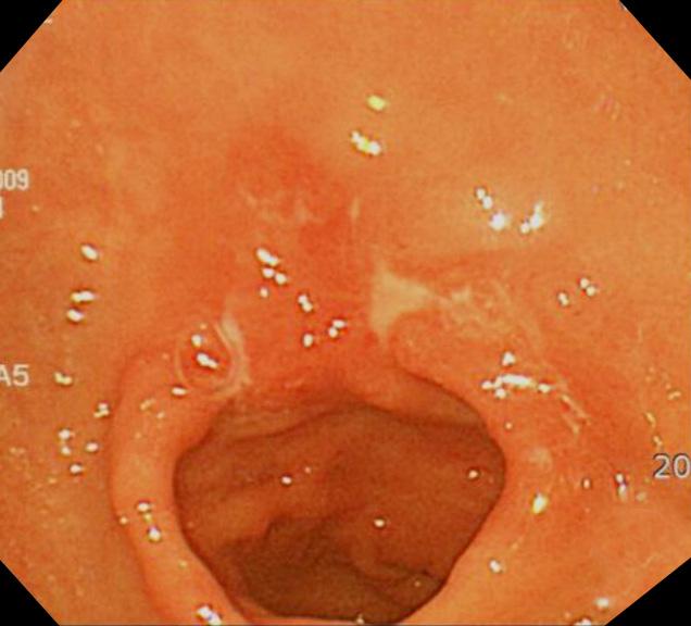 Korean J Helicobacter Up Gastrointest Res: Vol 15, No 3, September 2015 Fig. 1. Variable gastroscopic findings of Borrmann type 4 advanced gastric cancer (AGC).