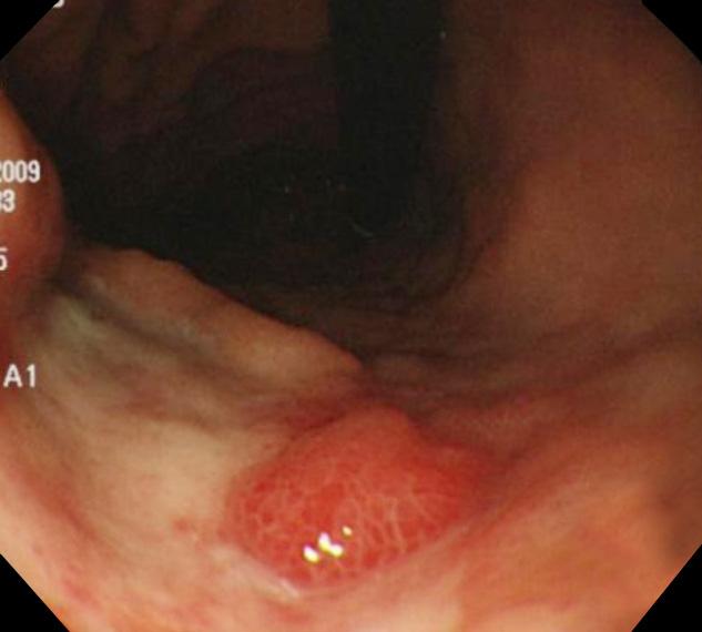 (D) An encircling infiltrative lesion consistent with Borrmann type 4 AGC with friable mucosa was noted at the prepyloric antrum. Table 2.