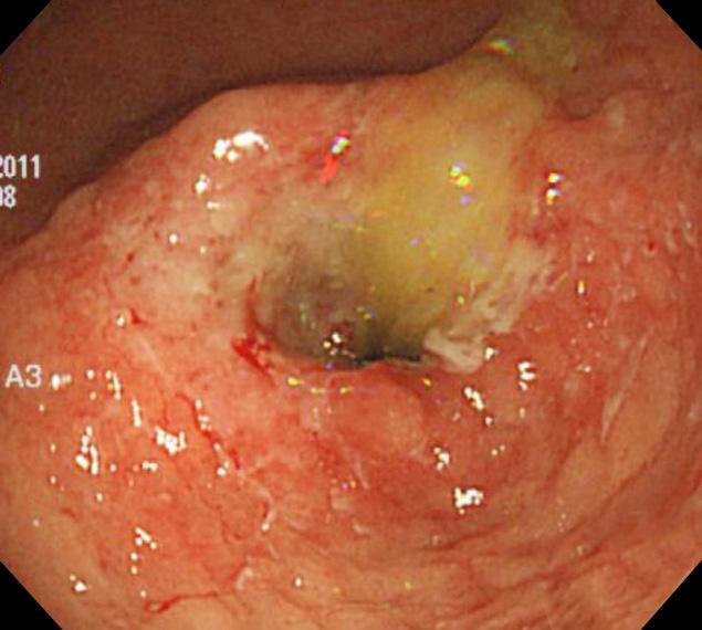 7) Ulceroinfiltrative mucosa (Borrmann type 3) 9 (37.5) Diffuse infiltrative mucosa (Borrmann type 4) 10 (41.7) Only hypertrophied mucosal fold 3 (30.