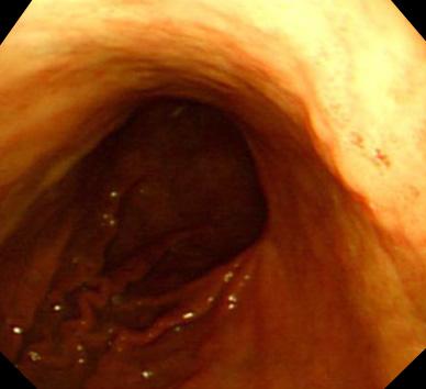 3) 0 (0) 1 (100) Early gastric cancer-mimicking lesion 1 0 (0) 1 (100) Total 24 3 (13.0) 20 (87.0) 2 (66.7) 1 (33.3) Values are presented as n (%).