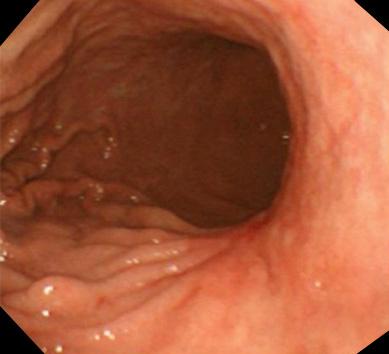 (A) Diffuse marked wall thickening with edematous mucosal changes were noted in the entire stomach.
