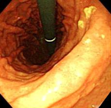 angle. (A, B) An initial gastroscopy revealed multiple benign gastric ulcers at the antrum and the angle.