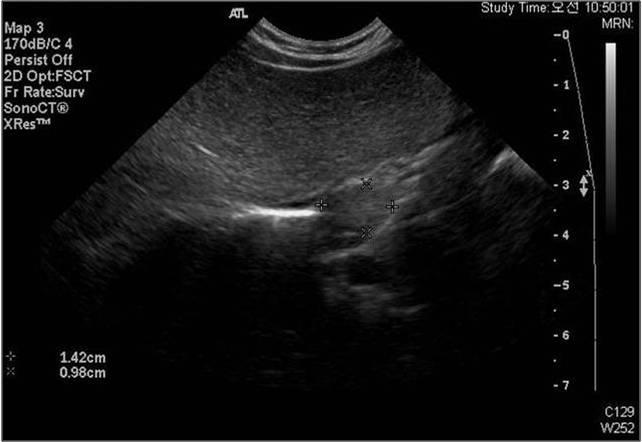 1 cm 크기의대동맥과좌심방, 횡격막으로둘러싸여있는폐종격동종괴가관찰되었다 (Fig. 1). 이종괴 Fig. 1. Transverse ultrasound image of fetal thorax, demonstrating about 1.