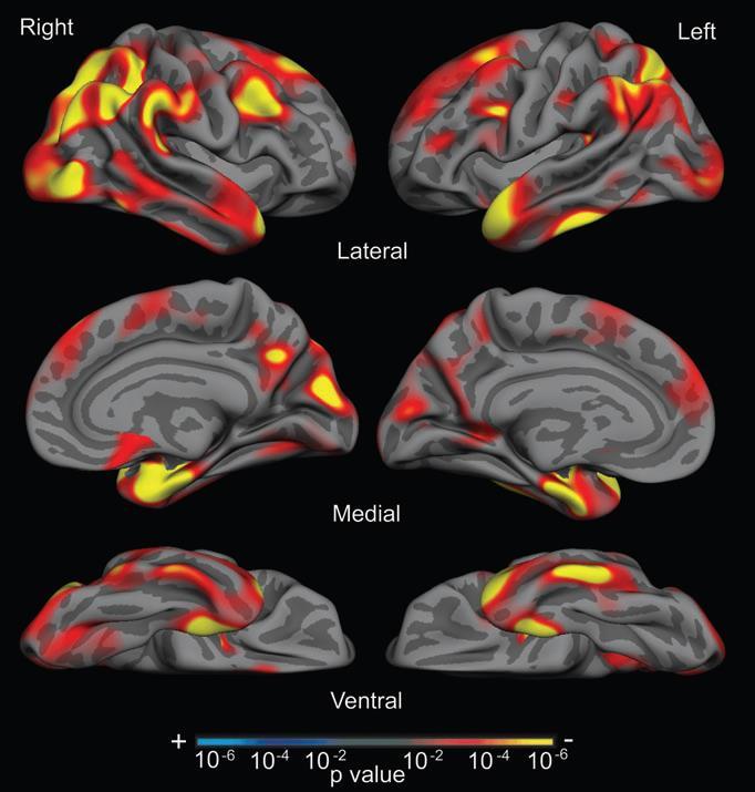 Brain atrophy in AD Signature cortical atrophy in AD -Bilateral medial temporal cortices