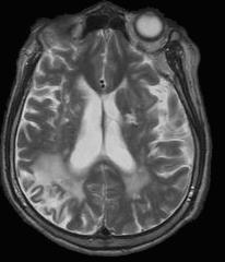 Multi-Infarct Dementia 다발성경색치매 큰혈관의폐색, 색전, 저관류-> 대뇌피질다발성손상