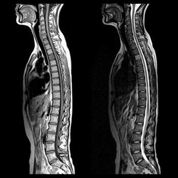 Spine MRI Check point T1 에서척추 ( 뼈 ) 골수의 signal T2 에서척수 (spinal cord) 의 signal T2 에서척추관 (spinal canal) 이좁아진부분은없는지