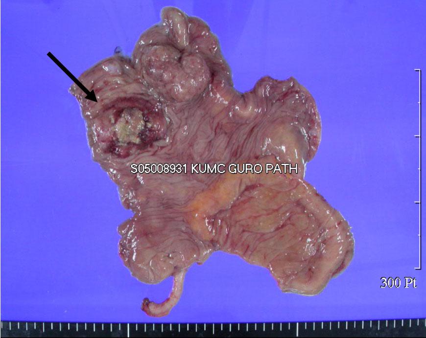 The mucosal surface shows a well demarcated fungating mass (dark arrow) and a large pedunculated polypoid mass (white arrow) in the ascending colon, measuring 4 3 cm across in the former and 4 3 cm
