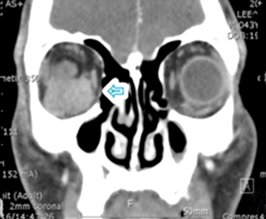 No evidence of adjacent bony erosion or intracranial extension.