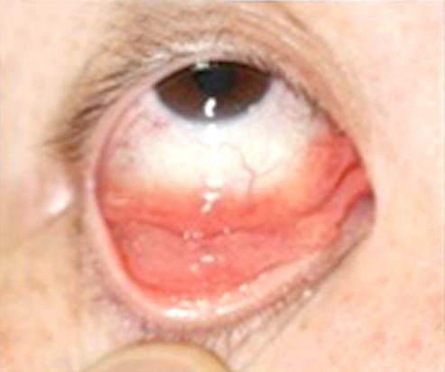- 박성진외 : 안와부속기 MALT 림프종에서 R CVP 치료효과 - A B C D Right eye Left eye Figure 5. Both eyes show lower conjunctival injection and salmon patch appearance mass-like lesion (A, C).
