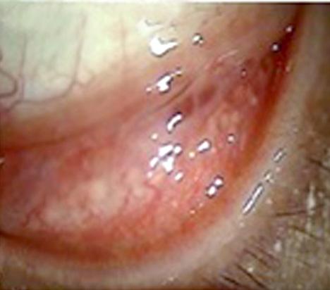 Eyelid 1 III CR Peripheral neuropathy (tingling sensation) 8 OS Orbit 1 II CR - 5 4 M/51 Lower lid swelling Conjunctival injection 5 M/31 Lower conjunctival injection OS Orbit 3 II CR URI Sx 4 Lower