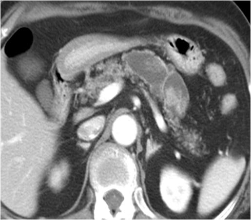 - 대한내과학회지 : 제 78 권제 3 호통권제 595 호 2010 - A B Figure 14. CT scan and endoscopic retrograde pancreatography of malignant intraductal papillary mucinous neoplasm.