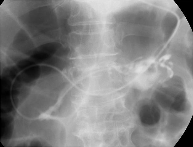 자기공명담췌관조영술 (magnetic resonance cholangiopancreatography, MRCP) 은점액이고여있어서확장되어있는췌관의범위를 ERCP보다는더민감하게보여주며분지관형의경우도쉽게주췌관과교통하는지알수있다. 분지형의경우는 MRCP에서낭성종양이포도송이모양으로보인다 ( 그림 12B).