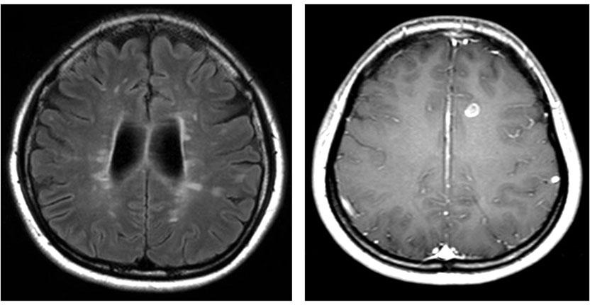 Kim WKim HJ A Figure 3. Representing MRI of multiple sclerosis.