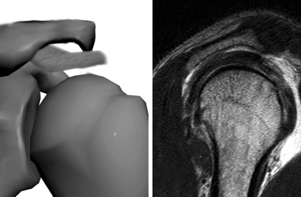 Magnetic resonance image of 55-year-old-male patient reveals subacromial enthesopathy with rotator cuff tear.