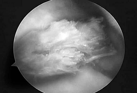 윤태현외 : 회전근개의손상환자에서외상성과퇴행성의감별 Fig. 10. iceps tendon fraying or tear is evidence of chronic rotator cuff injury. Fig. 11.