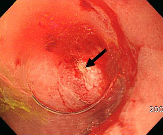 Intrahepatic bile duct dilatation 3 Hook-shaped CBD 8 Visualization of pancreatic duct 3 Pneumobilia 1 ( ), total; ERCP, endoscopic retrograde cholangiopancreatography; PTC, percutaneous